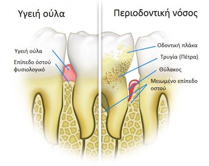Περιοδοντίτιδα, Οδοντίατροι Θεσσαλονίκη