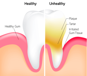 Υγεία ούλων