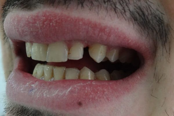 Όψεις Πορσελάνης