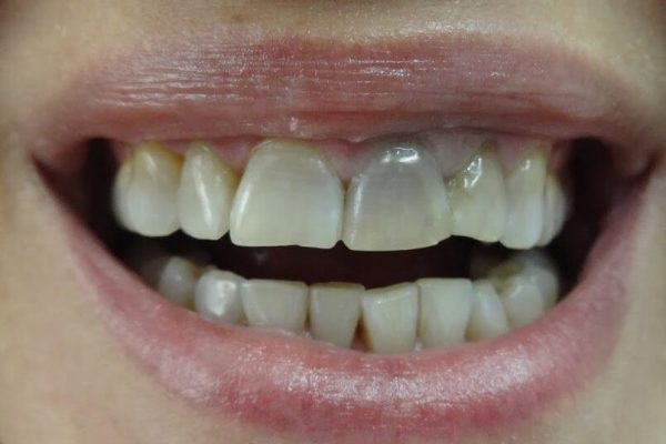 Όψεις Ρητίνης