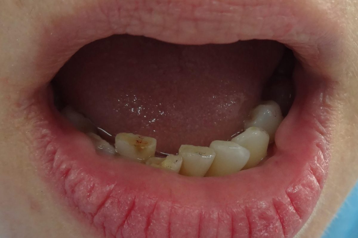 Όψεις Ρητίνης-Bonding