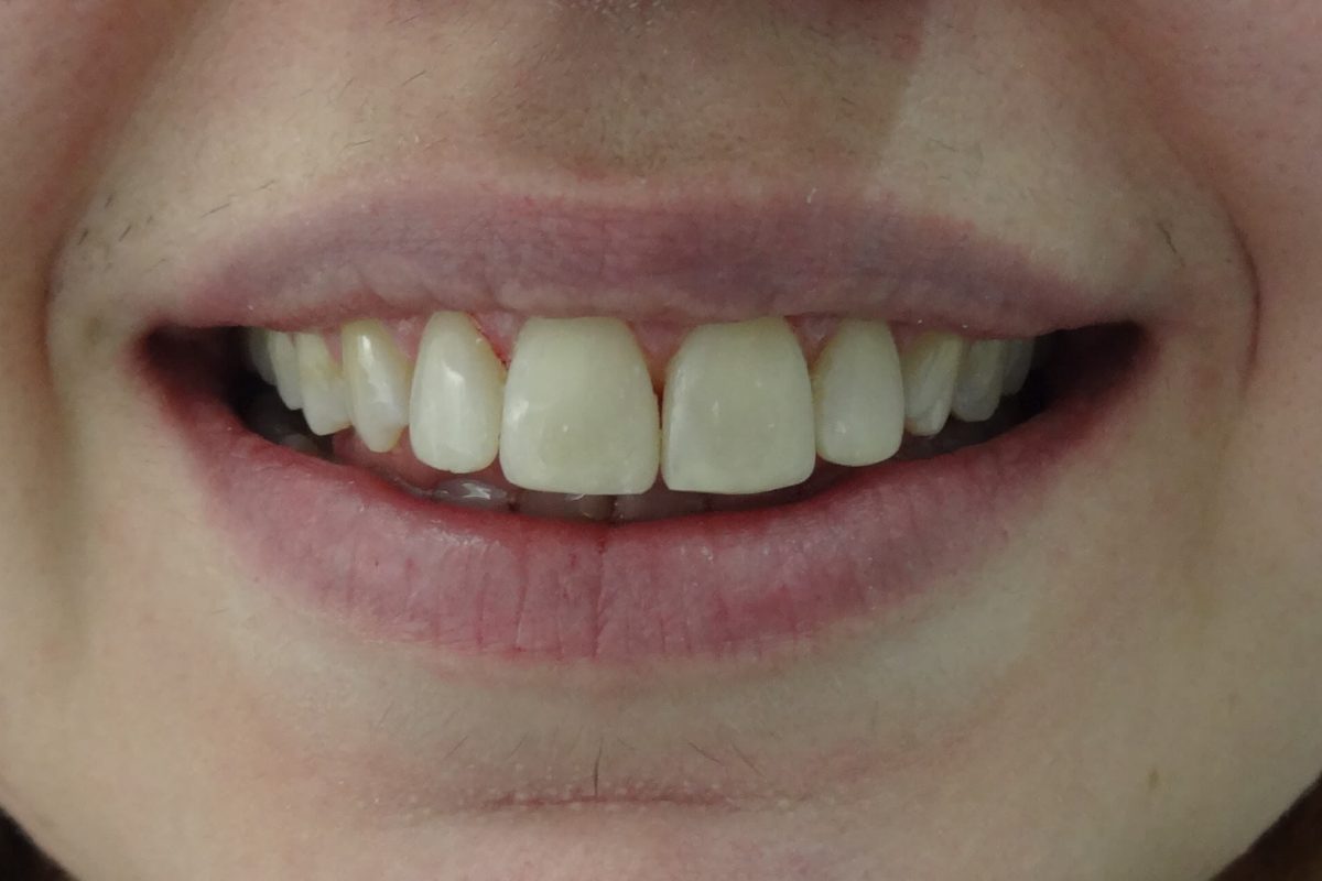 Όψεις Ρητίνης-Bonding