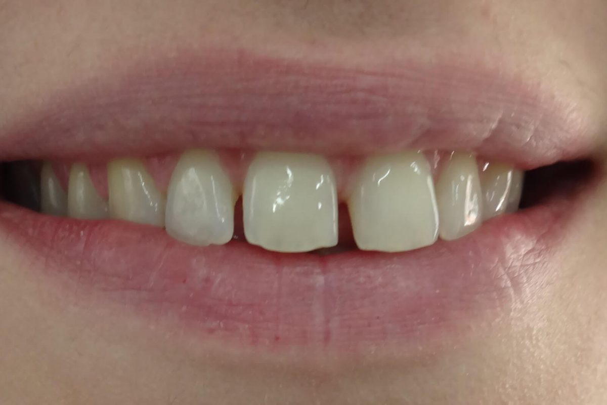 Όψεις Ρητίνης-Bonding