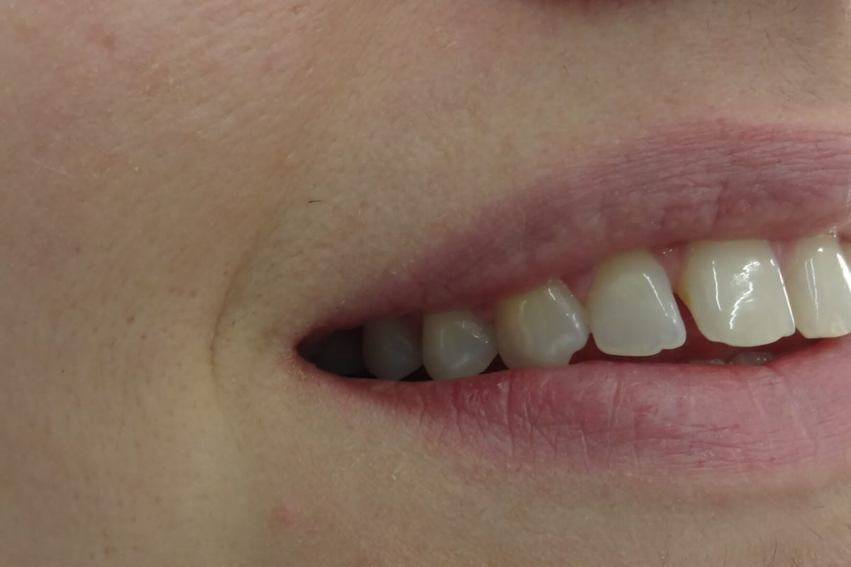 Όψεις Ρητίνης-Bonding