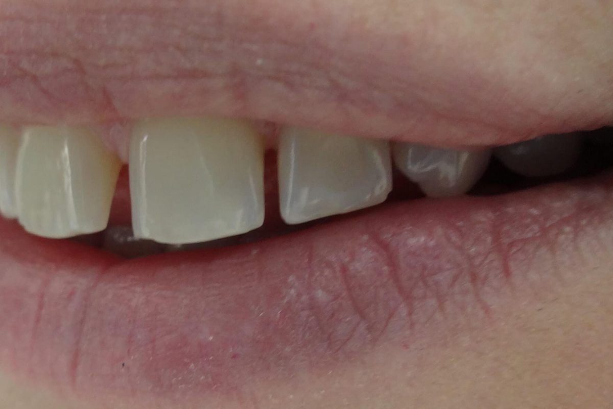 Όψεις Ρητίνης-Bonding