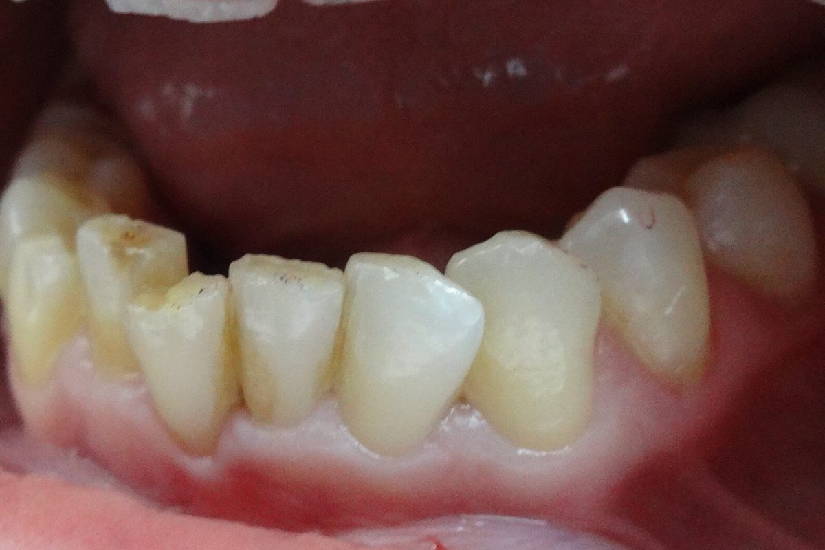 Όψεις Ρητίνης-Bonding