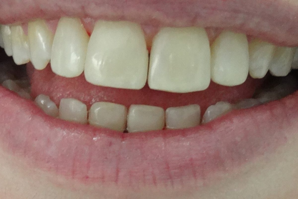 Όψεις Ρητίνης-Bonding