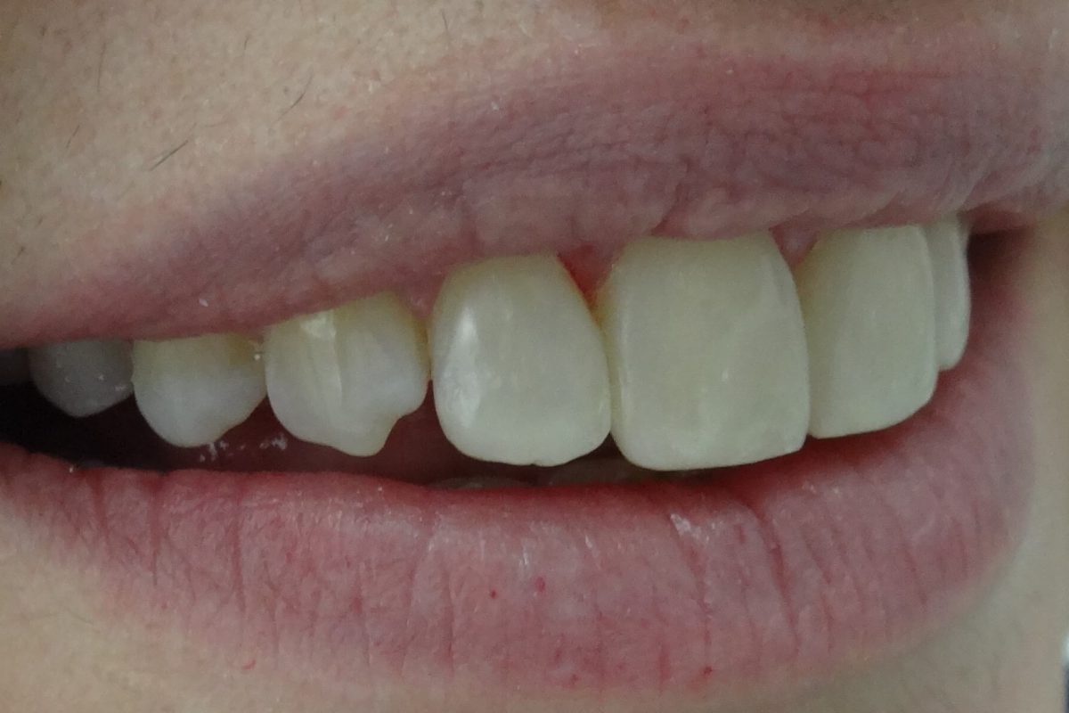 Όψεις Ρητίνης-Bonding