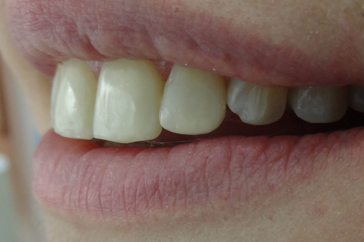 Όψεις Ρητίνης-Bonding