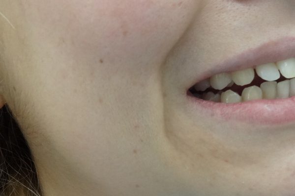 Οδοντίατρος Θεσσαλονίκη-Όψεις Ρητίνης