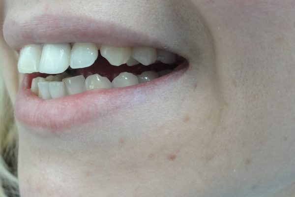 Οδοντίατρος Θεσσαλονίκη-Όψεις Ρητίνης