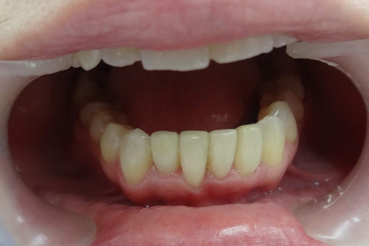 Όψεις Ρητίνης-Bonding