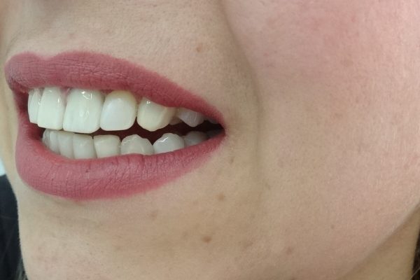 Οδοντίατρος Θεσσαλονίκη-Όψεις Ρητίνης