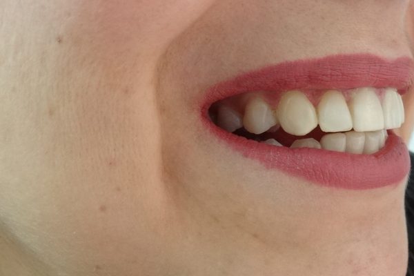 Οδοντίατρος Θεσσαλονίκη-Όψεις Ρητίνης