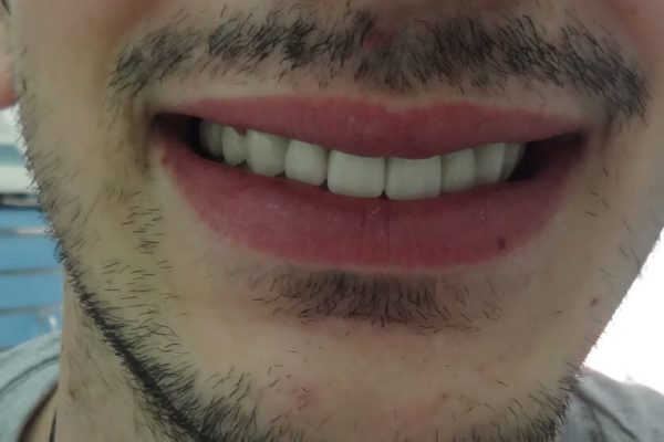 Όψεις Πορσελάνης