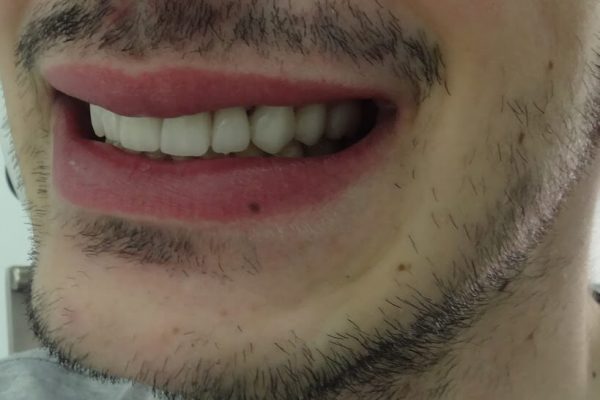 Όψεις Πορσελάνης