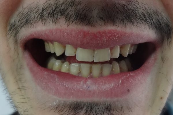 Όψεις Πορσελάνης