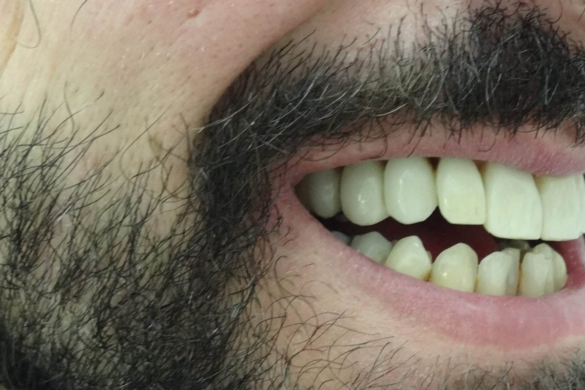 Ορθοδοντική χωρίς Σιδεράκια