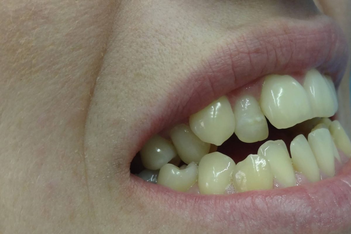 Ορθοδοντική Δοντιών χωρίς Σιδεράκια