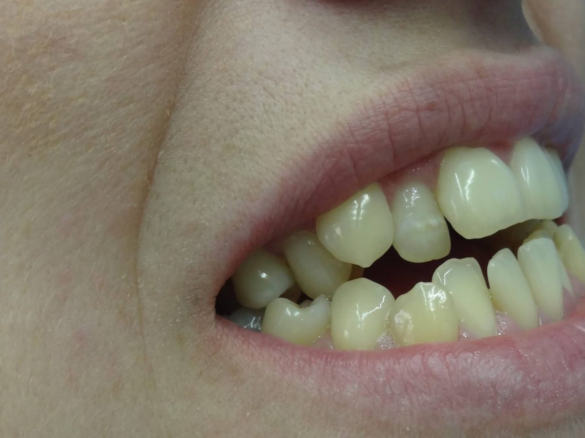 Ορθοδοντική Δοντιών χωρίς Σιδεράκια