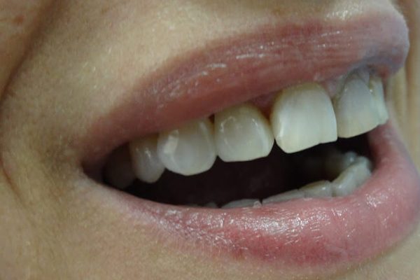 Όψεις Ρητίνης