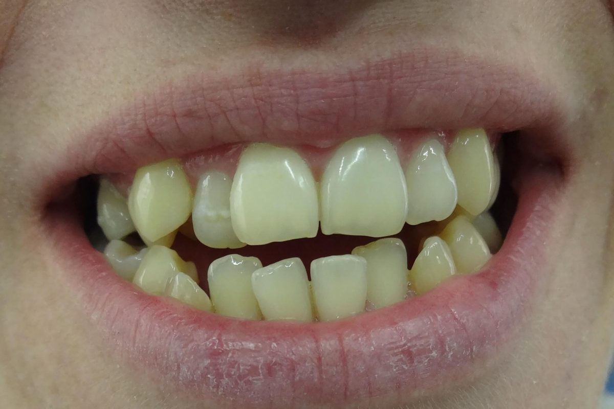 Ορθοδοντική Δοντιών χωρίς Σιδεράκια