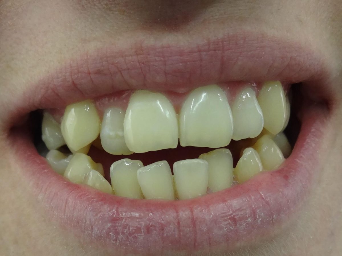 Ορθοδοντική Δοντιών χωρίς Σιδεράκια