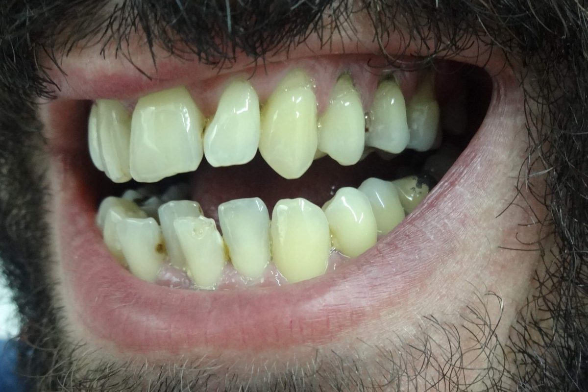 Ορθοδοντική χωρίς Σιδεράκια