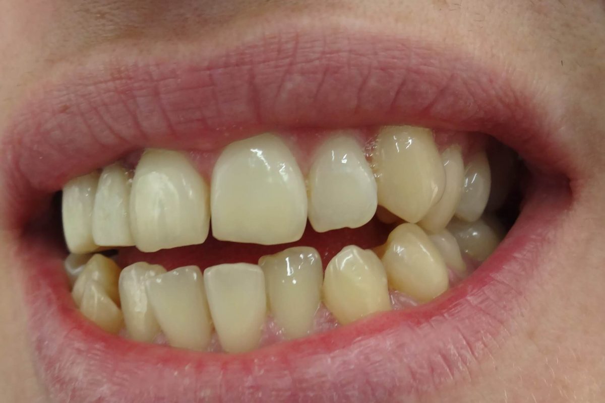 Όψεις Ρητίνης-Ορθοδοντική χωρίς Σιδεράκια