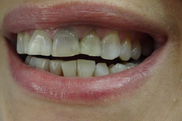 Όψεις Ρητίνης