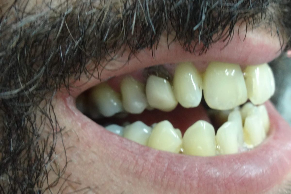 Ορθοδοντική χωρίς Σιδεράκια