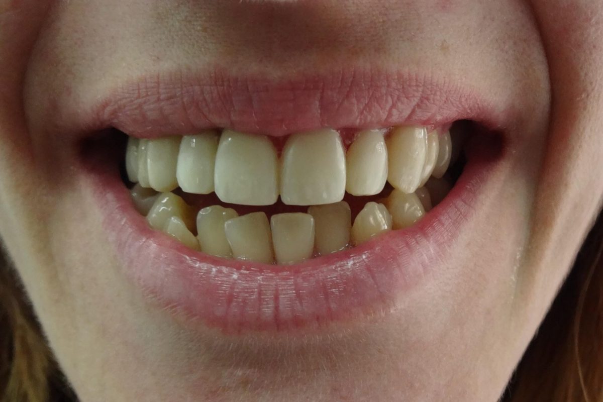 Όψεις Ρητίνης-Ορθοδοντική χωρίς Σιδεράκια