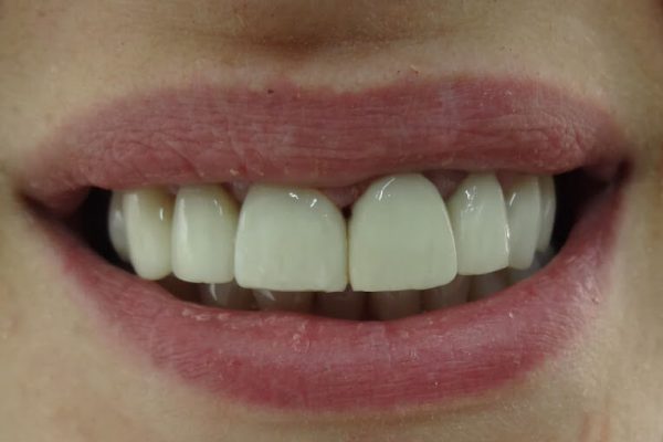 Όψεις Ρητίνης