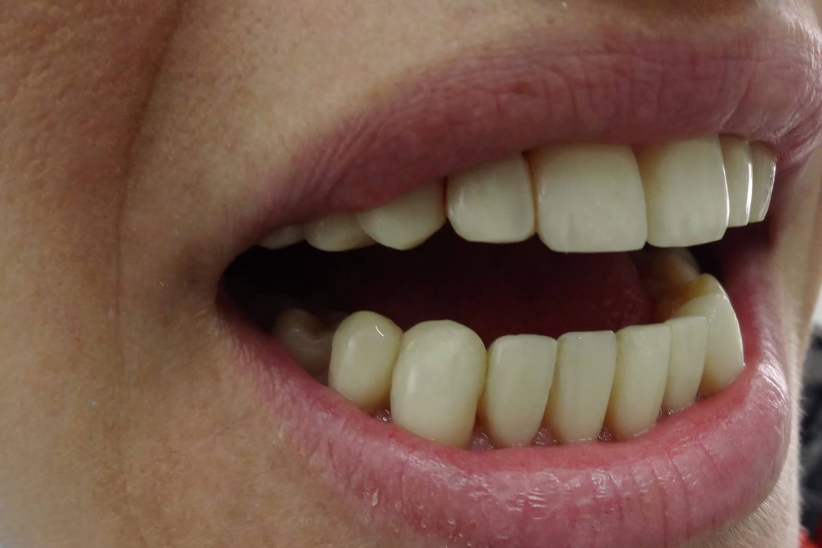 Όψεις Ρητίνης-Ορθοδοντική χωρίς Σιδεράκια