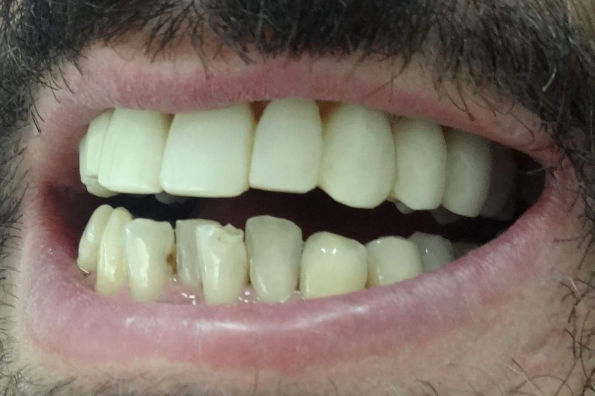 Ορθοδοντική χωρίς Σιδεράκια