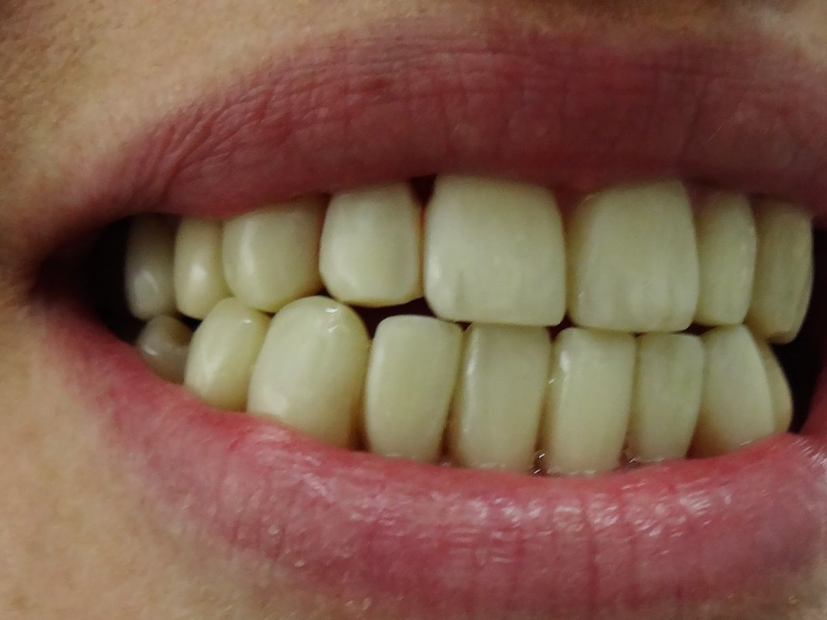 Ορθοδοντική Δοντιών χωρίς Σιδεράκια