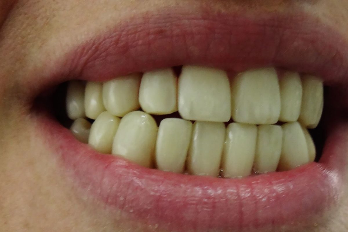 Ορθοδοντική Δοντιών χωρίς Σιδεράκια