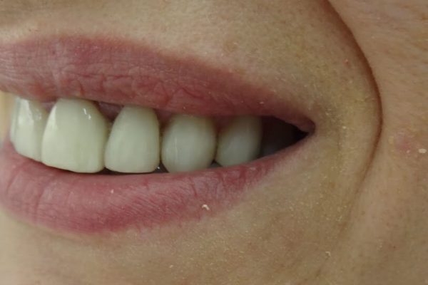 Όψεις Ρητίνης