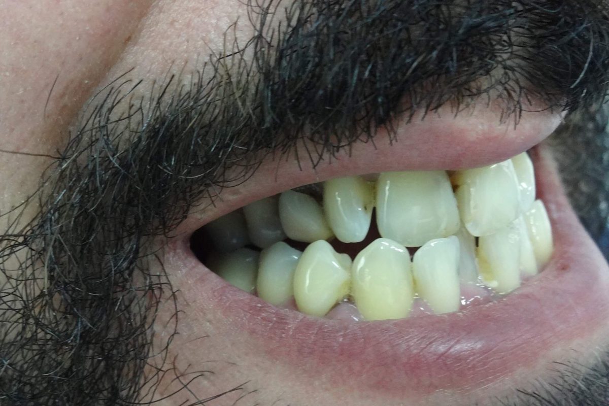 Ορθοδοντική χωρίς Σιδεράκια