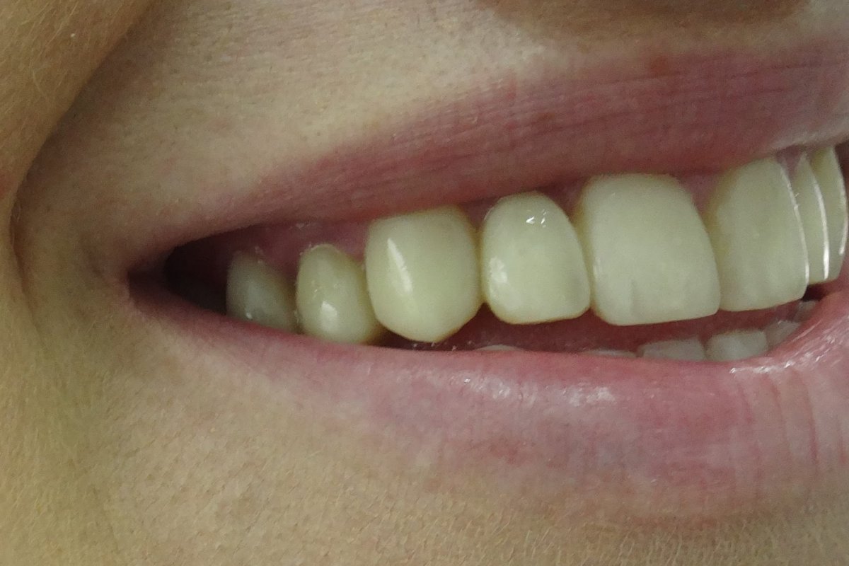 Ορθοδοντική Δοντιών χωρίς Σιδεράκια