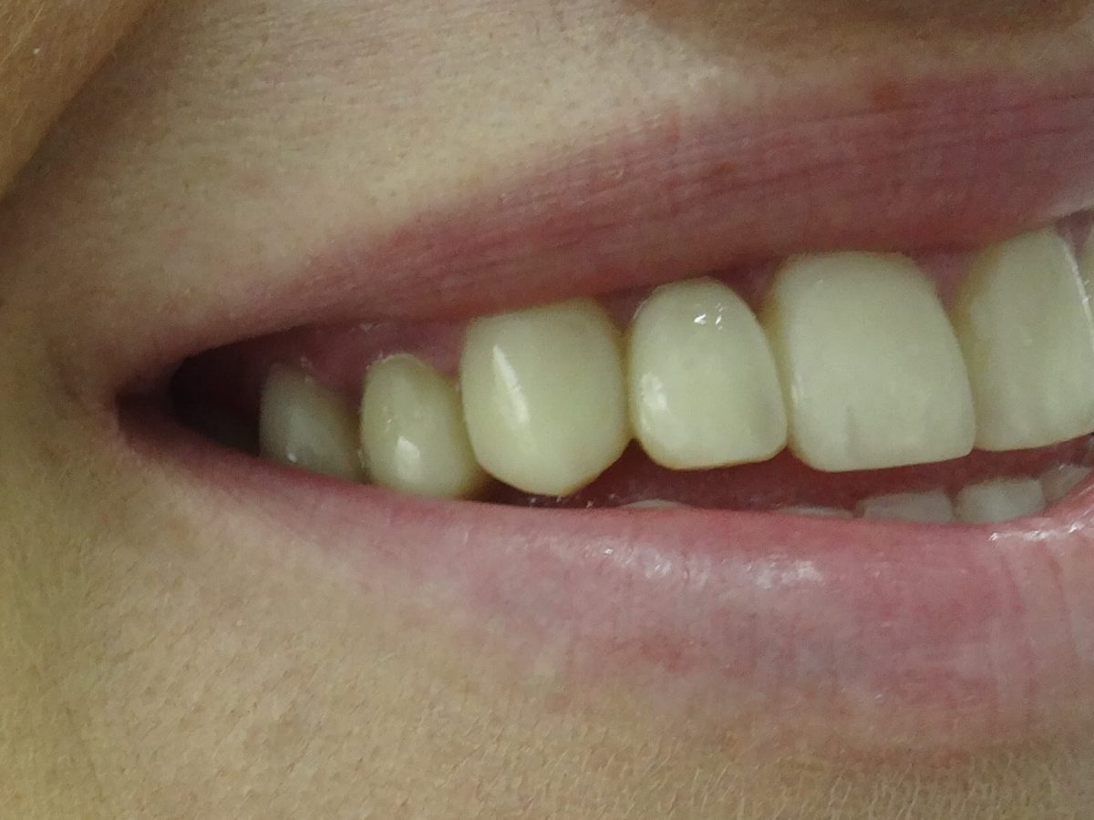 Ορθοδοντική Δοντιών χωρίς Σιδεράκια