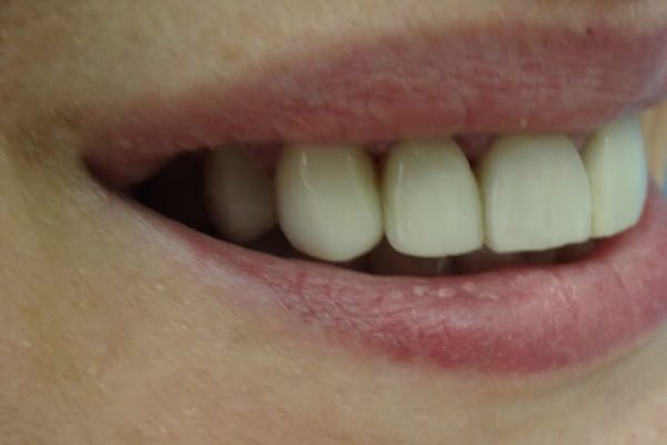 Όψεις Ρητίνης