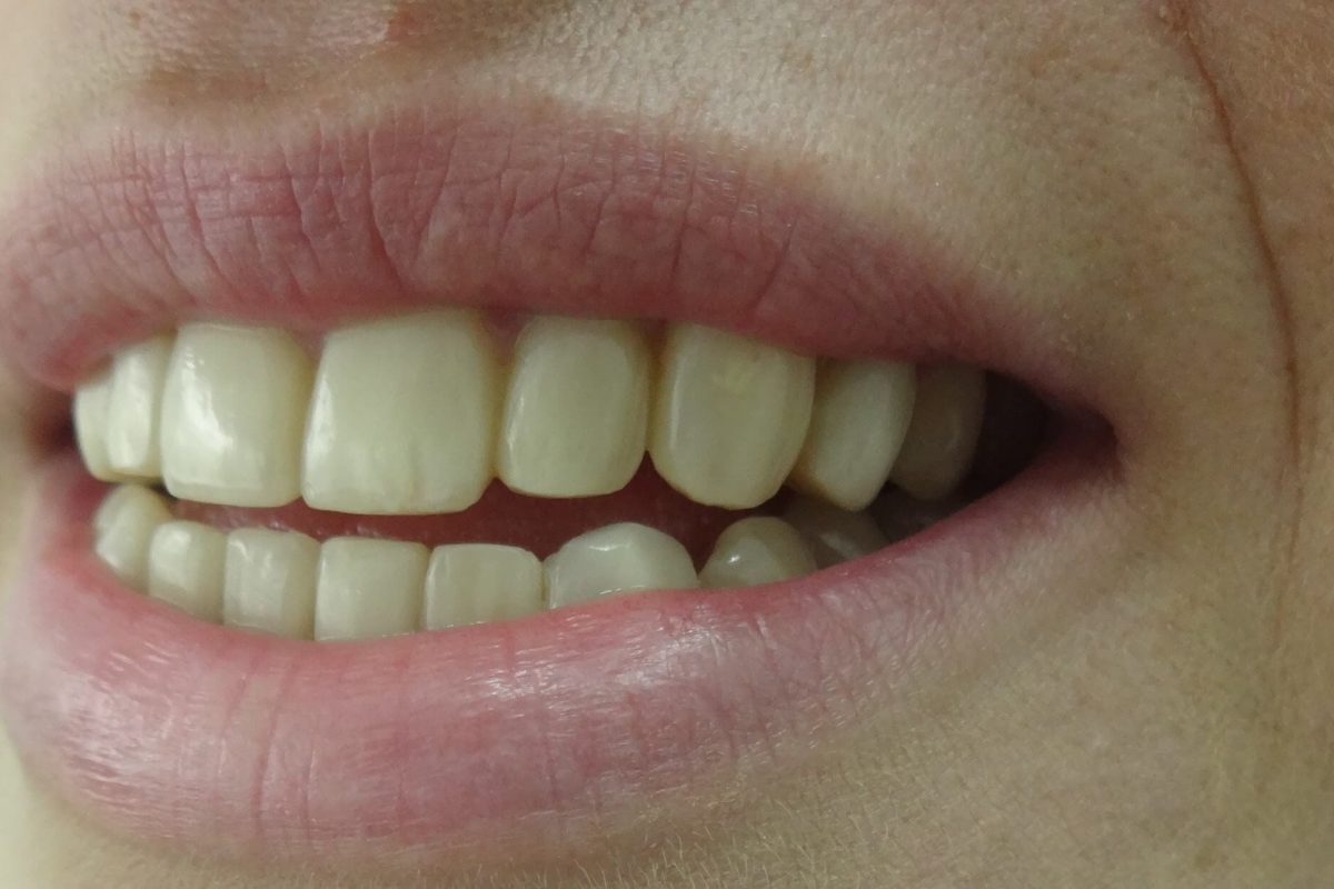 Όψεις Ρητίνης-Ορθοδοντική χωρίς Σιδεράκια