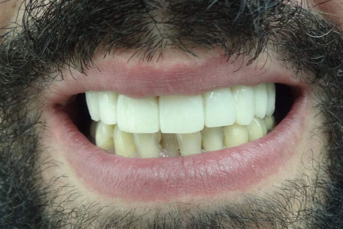 Ορθοδοντική χωρίς Σιδεράκια