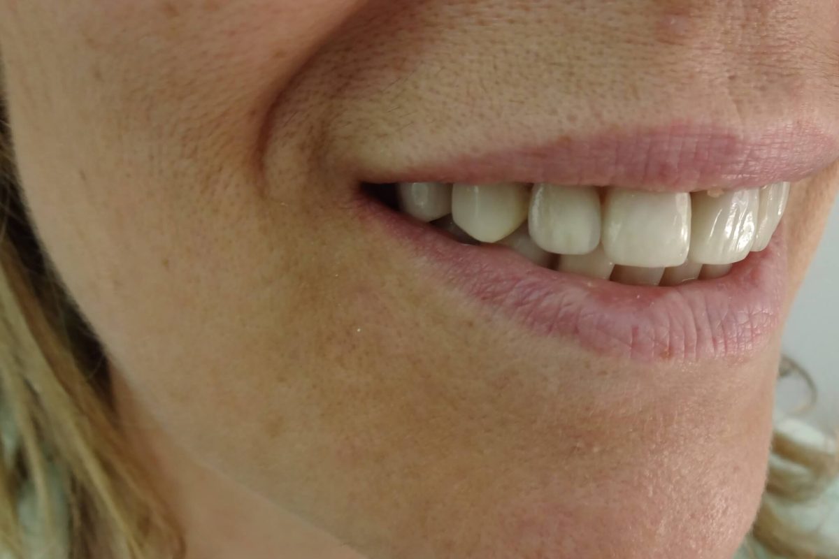 Όψεις Ρητίνης-Bonding