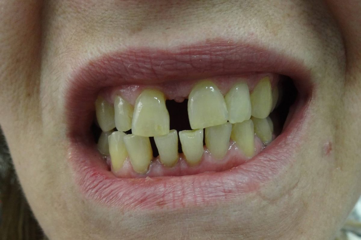 Όψεις Ρητίνης-Bonding