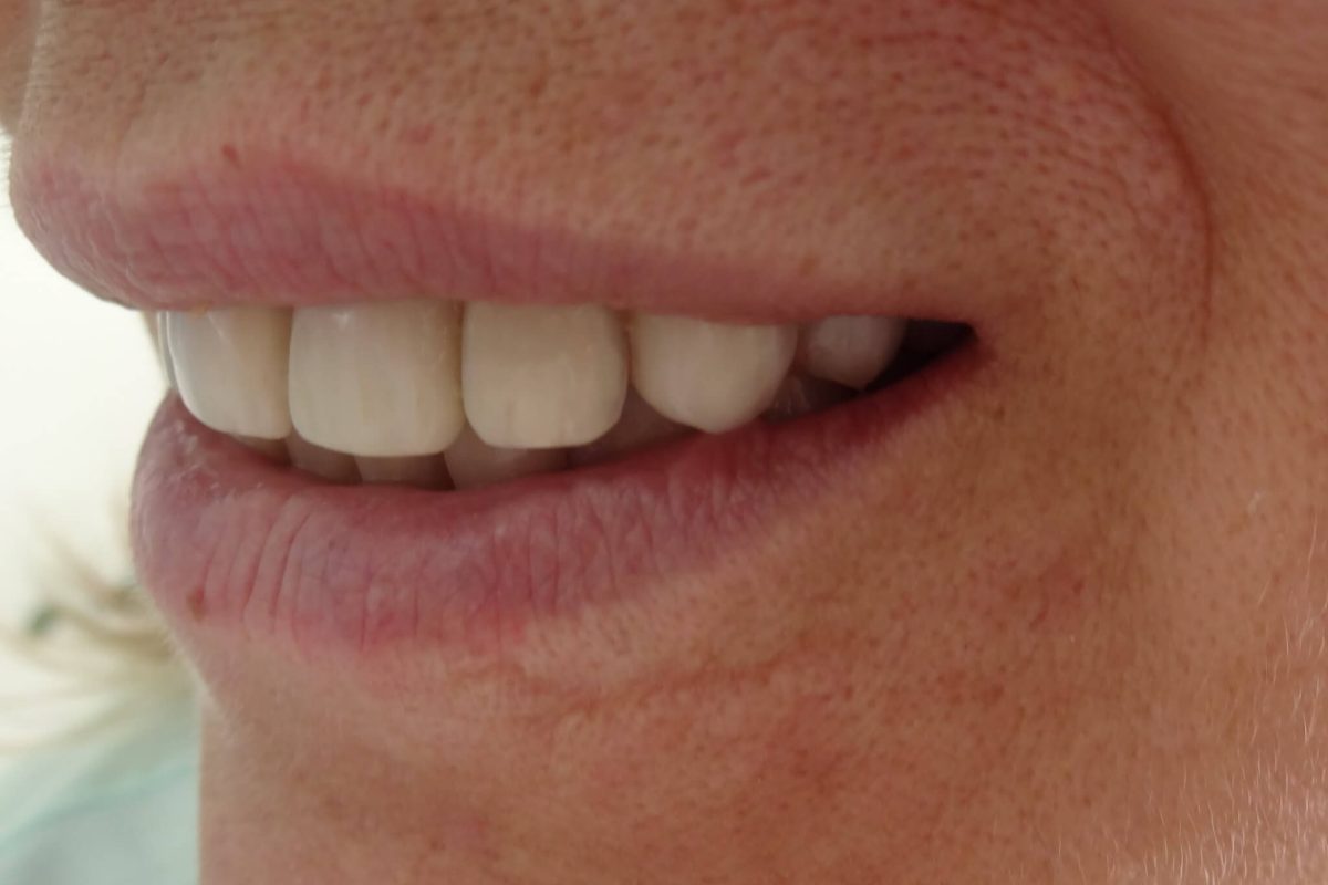 Όψεις Ρητίνης-Bonding