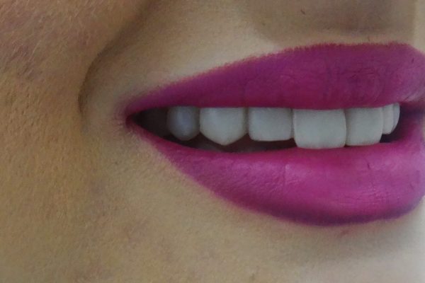 Όψεις Ρητίνης-Bonding