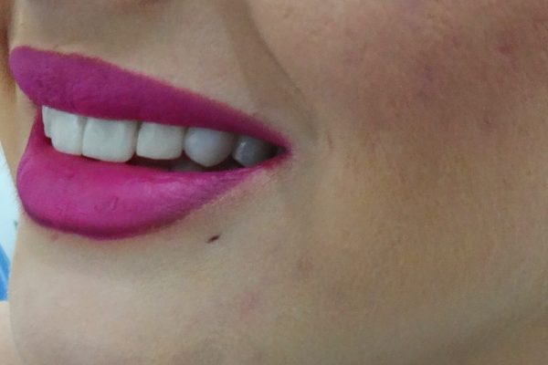 Όψεις Ρητίνης-Bonding