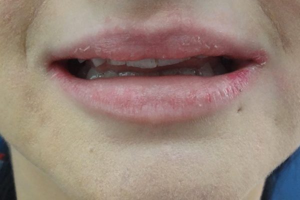 Όψεις Ρητίνης-Bonding